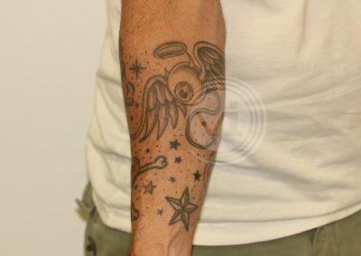 Black forearm tattoo before laser