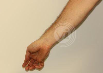 Black inner wrist sun tattoo after laser removal