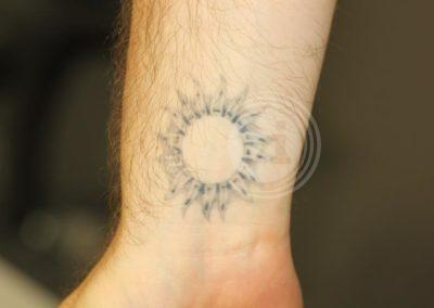 Black inner wrist sun tattoo before laser