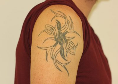 Black scarred shoulder tattoo before laser tattoo removal