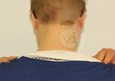 Black neck tattoo after laser removal