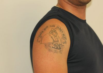Black shoulder tattoo before laser tattoo removal