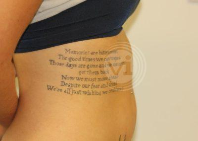 Black text on ribs tattoo before laser