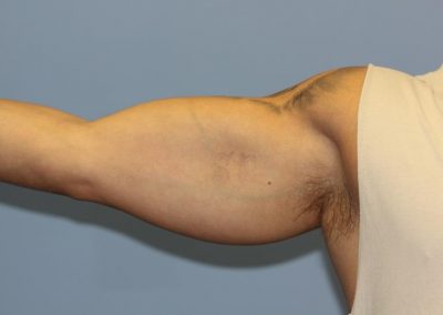Black Inner Bicep Tattoo Fade After Laser Tattoo Removal