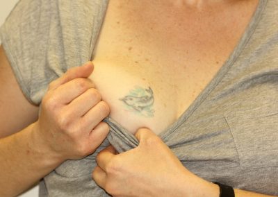 Breast Dolphin Tattoo Before Laser