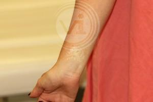 Wrist scar after 4 treatments