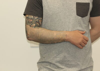 Coloured Forearm tattoo after 9 laser treatments