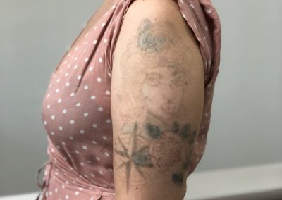 Colourful Shoulder Tattoo After Laser