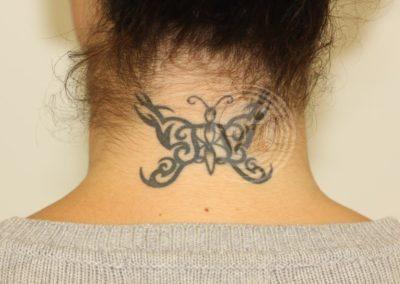 Dark black butterfly neck tattoo before laser