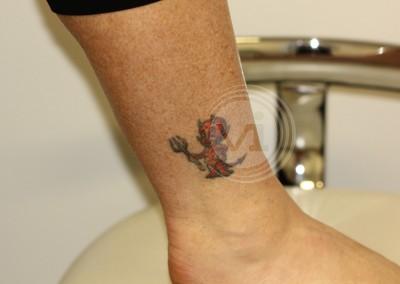 Black and red ankle tattoo before treatment