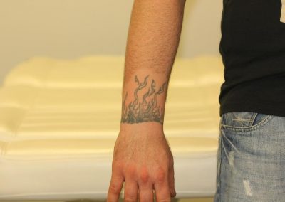 Flaming Wrist Tattoo Before Laser