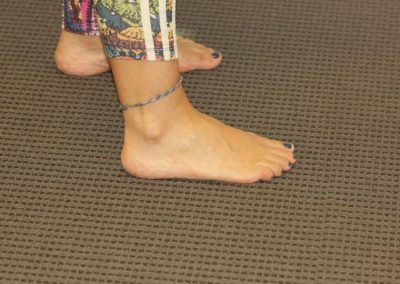 Coloured Foot Tattoo After Laser