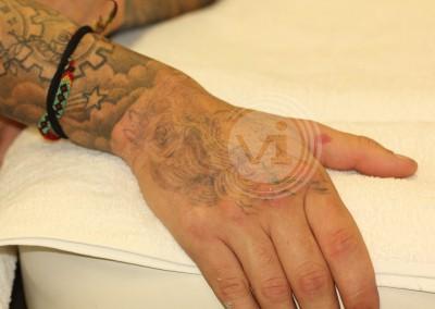 Hand tattoo after 4 treatments
