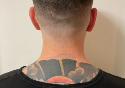 Large Black Head Tattoo After 6 Txs