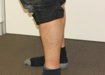 Large Black Leg Tattoo After 5 Laser Treatments