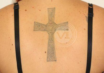 Large black cross tattoo on back before laser