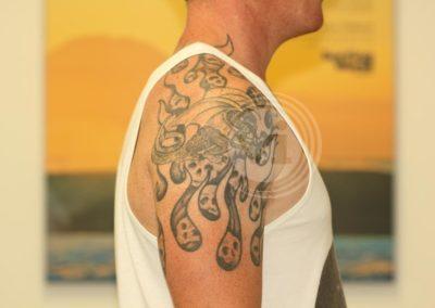 Large black shoulder tattoo before laser