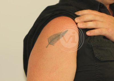 Black shoulder tattoo before laser removal